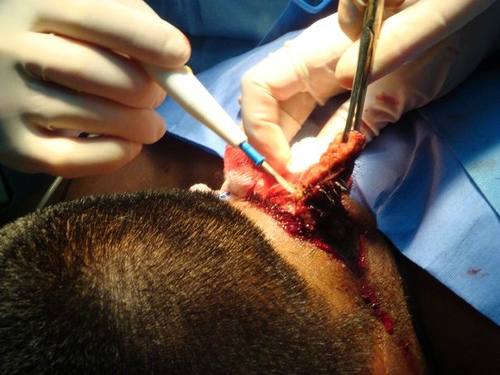 Infected Hair Follicle Treatment