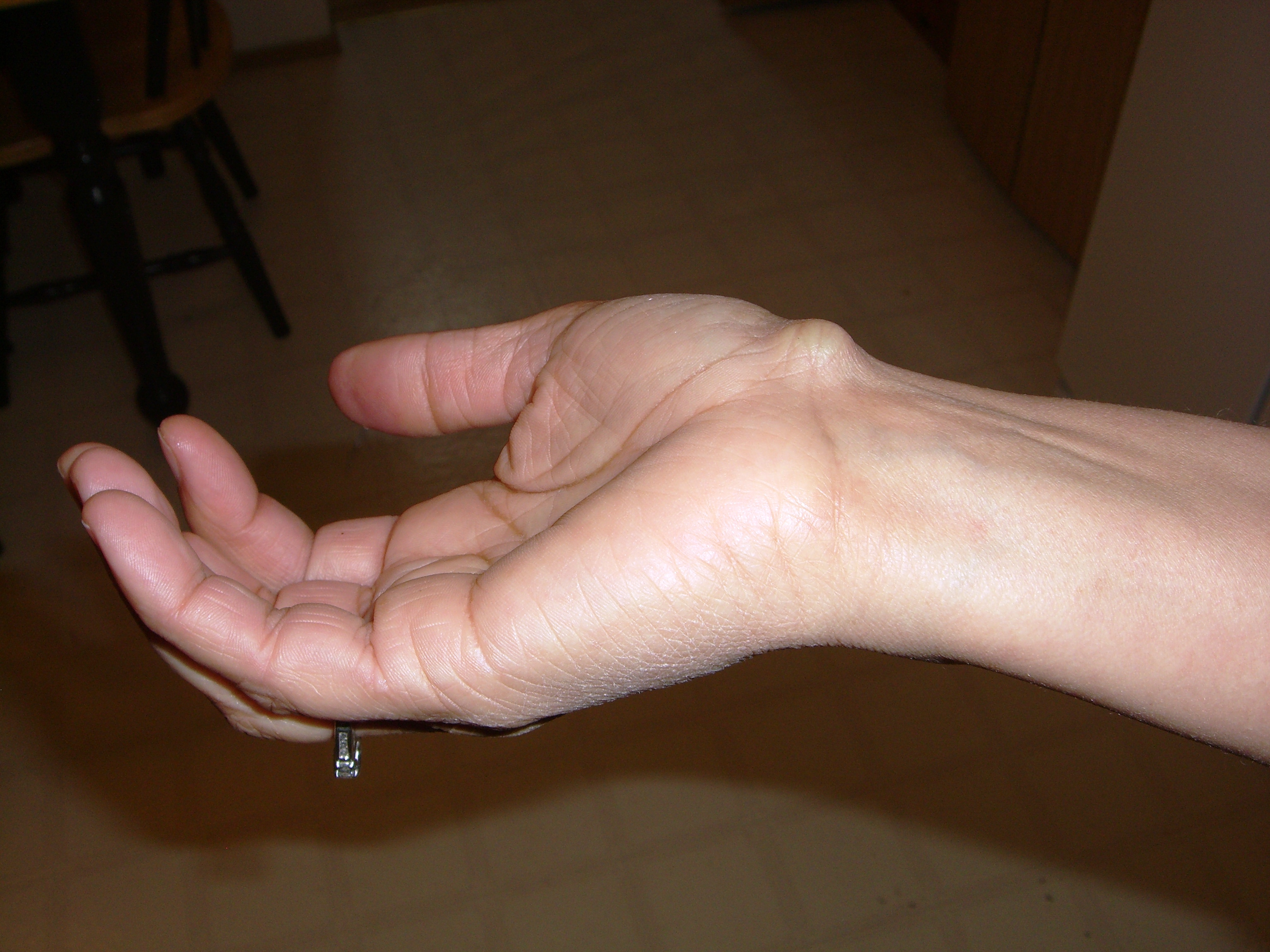 Ganglion Cysts Finger