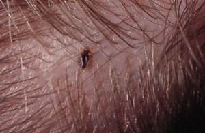 head lice