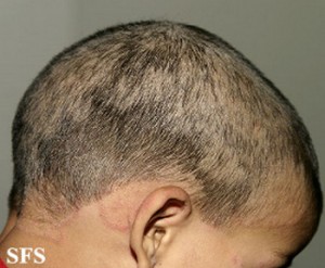 Natural Treatments For Ringworm Of The Scalp Natural Treatments For Ringworm Of The Scalp