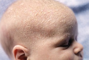 Infant Seborrhoeic Dermatitis. Cradle Cap; Information ...