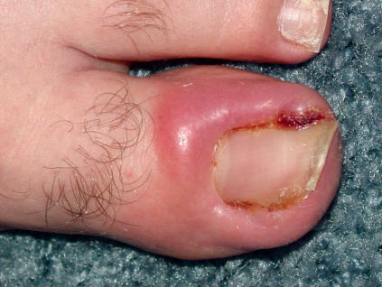 Symptoms of Infected Ingrown Toenail. ingrown toenail reasons