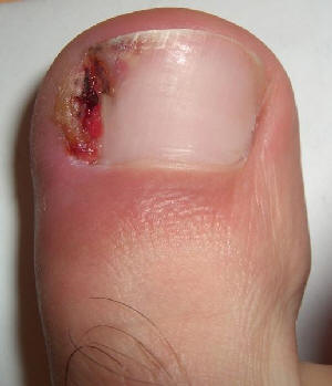 Nail Infection On Big Toe@^*