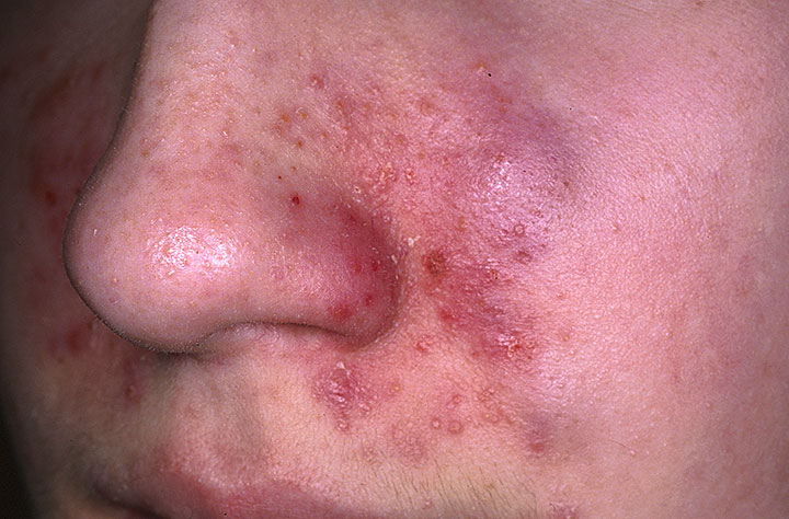 seborrheic dermatitis face pictures