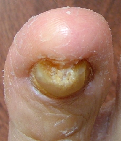 The aged are the most affected by toenail fungus and diabetics and HIV