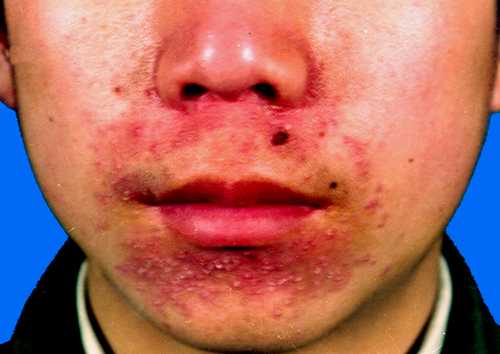 dermatitis perioral