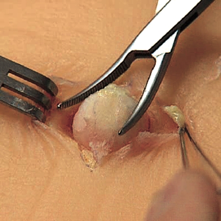 retention cysts or sebaceous cysts. Epidermoid cyst stitches