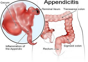 Appendix Pain Causes