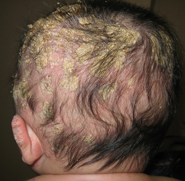 Cradle Cap – Treatment, Pictures and Home Remedies, Causes