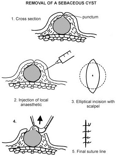 Sebaceous Cyst Epidermal Cyst Pictures Causes Treatment And Removal