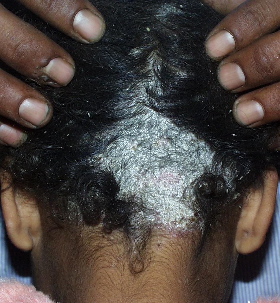 Tinea capitis (schimmelinfectie van het behaarde hoofd)