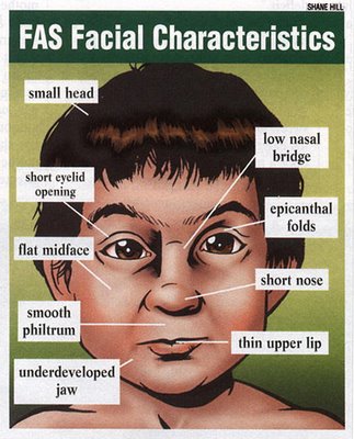 fetal alcohol syndrome. What is Fetal Alcohol Syndrome
