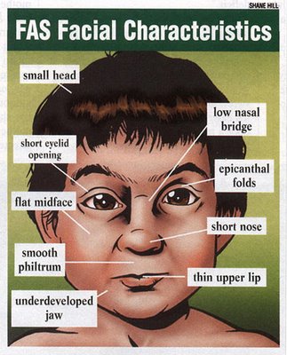 Alcohol facial feature fetal syndrome