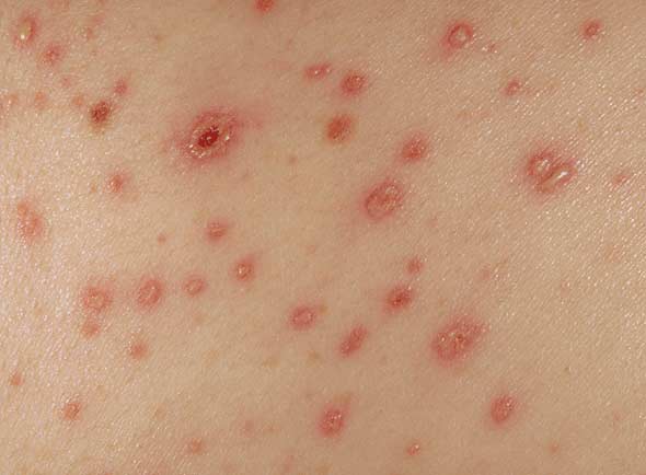 Maculopapular Rash - Pictures, Causes, Diagnosis, Treatment