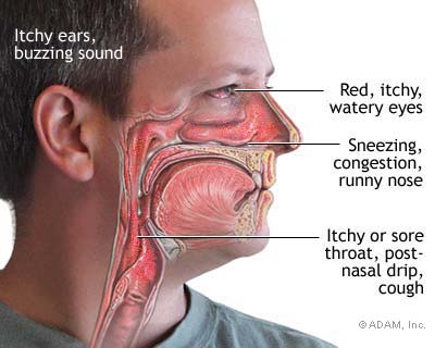 Steroid nose spray for sinus infection