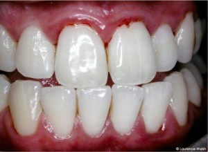 sore gums due to teeth whitening