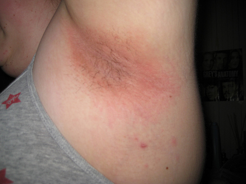 underarm rash pictures