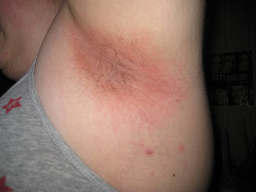 rash in armpits