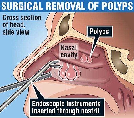 Steroid nasal spray infection