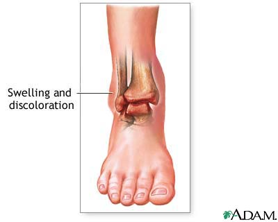 Does diabetes cause swollen ankles?