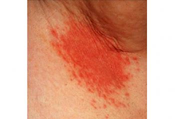 Armpit Rash - Dermatology - MedHelp