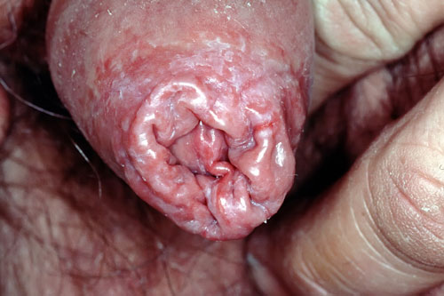 anal assholes gaping sex balanoposthitis adult prevention