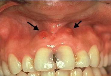 Toddler Has Swollen Gums With Blister.