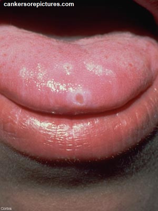 herpes mouth ulcers. Canker Sores on Tongue