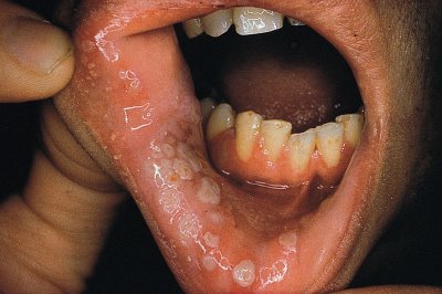 canker sore sores mouth tongue symptoms causes non lips disease herpes