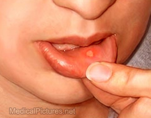 sores on tongue. Picture 4 – Canker Sore on