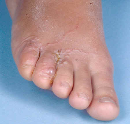 Itchy Hands and Feet | MD-Health.com