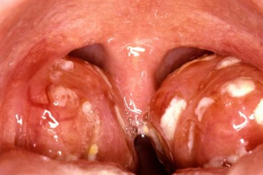 Treating swollen tonsils with steroids