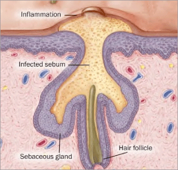 Sebaceous-Gland.gif