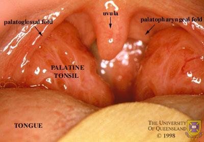 Swollen Tonsil pictures