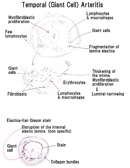 What are some treatments for temporal arteritis?