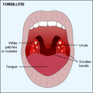 Infected Tonsils Pics