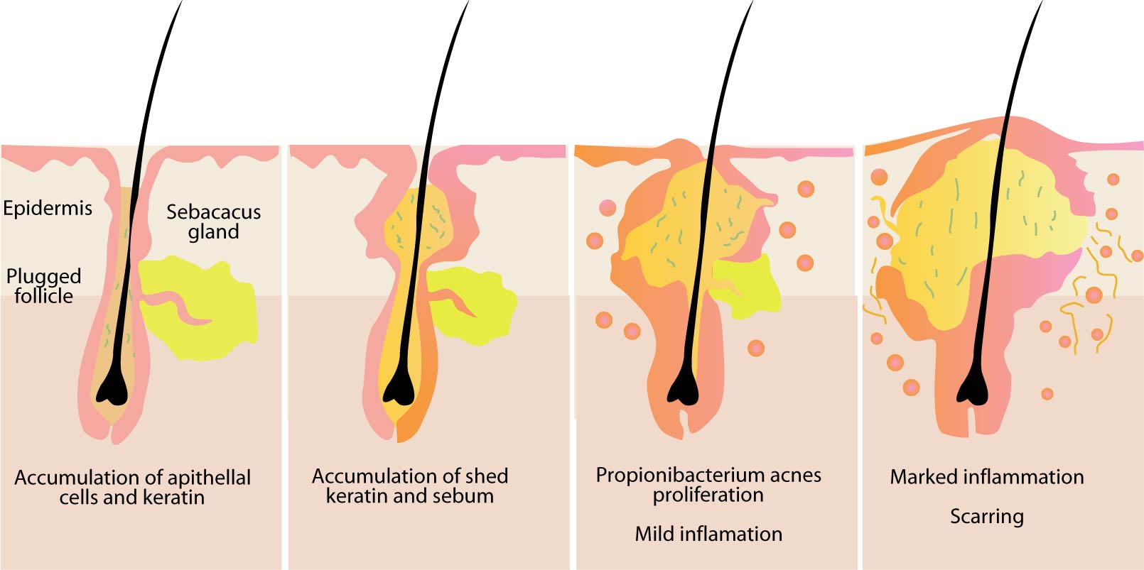 Cystic Acne Diagram