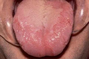 Sore or painful tongue - NHS Choices