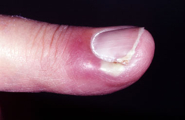 paronychia fingernail