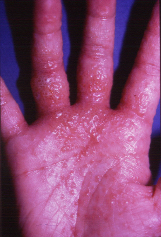 Pompholyx (Dyshidrotic Eczema). Pompholyx Treatment | Patient