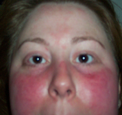 What causes a butterfly-shaped skin rash in people with lupus?