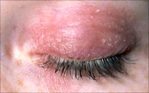 Eyelid redness, Itching or burning, Puffy eyelids and Red ...