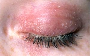 rashes on eyelid #10