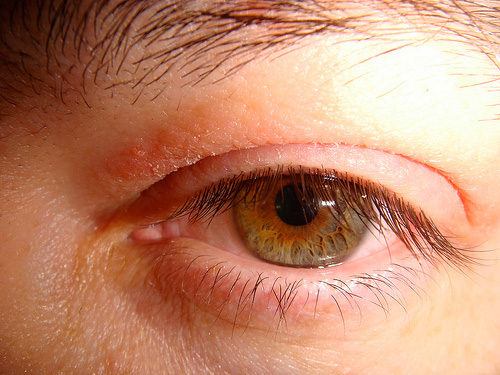 dry spots on eyelid
