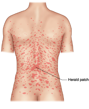 Pityriasis Rosea Herald Patch On Back