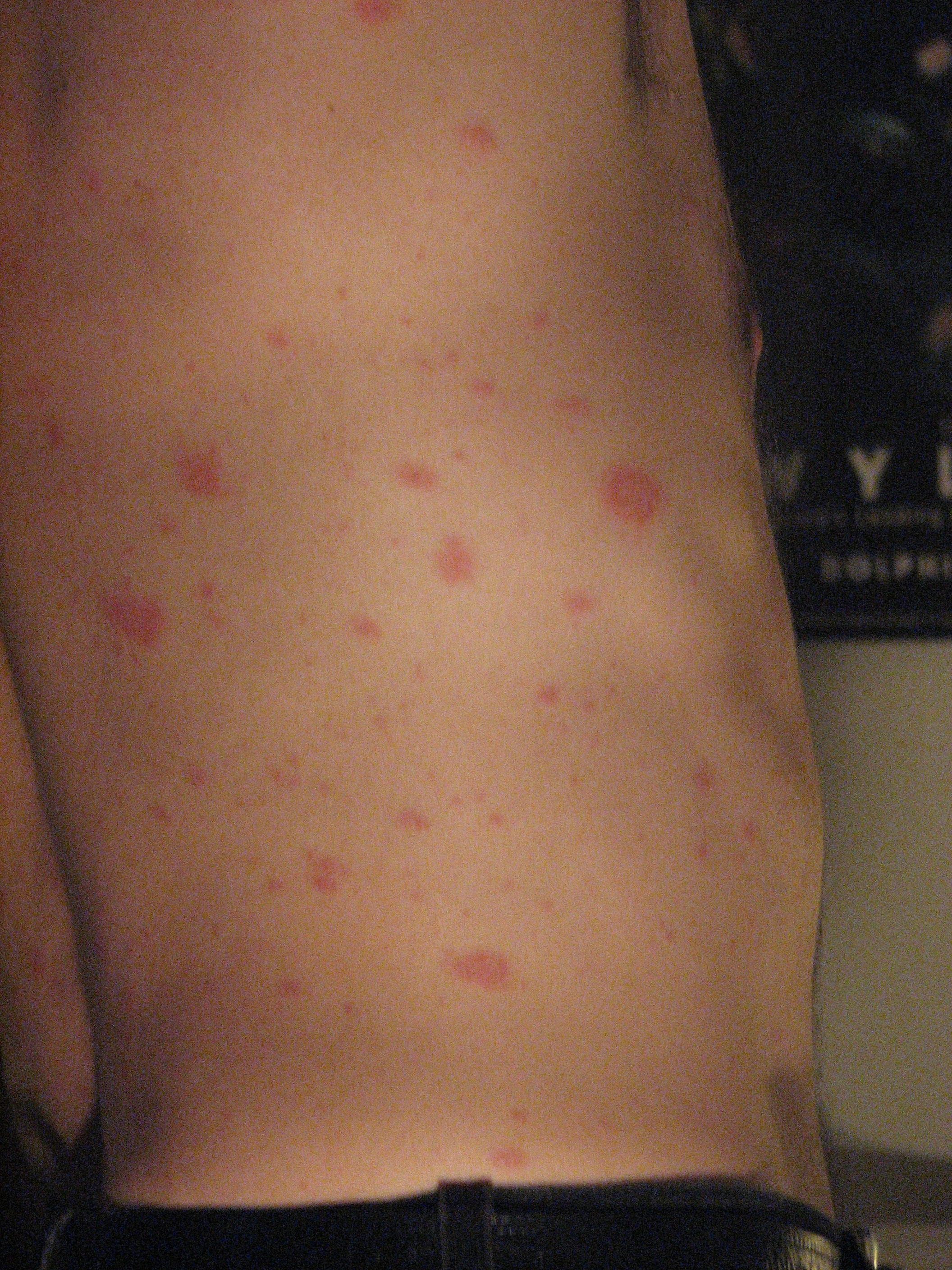 Pityriasis Rosea Photos - Dermatology Education