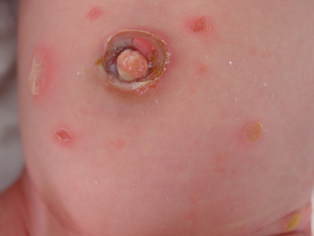 Impetigo: MedlinePlus Medical Encyclopedia