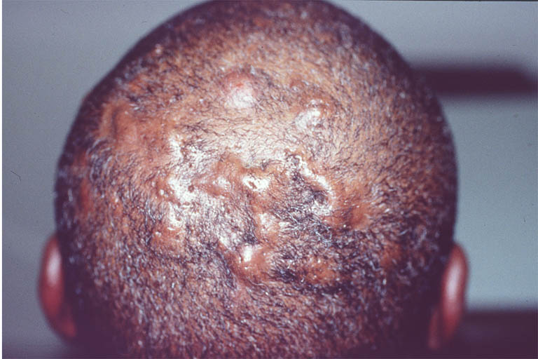 pseudomonas folliculitis #10