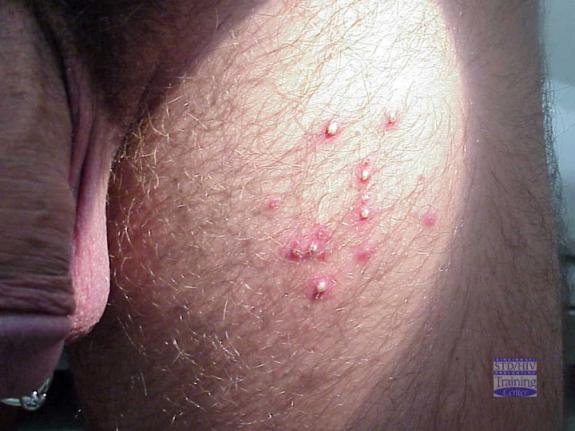 Mild Folliculitis Treatment - Doctor answers on HealthTap