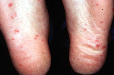 Hand Foot And Mouth Virus In Adults 67